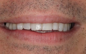 crooked-teeth-fixed